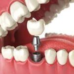 How much Should Bone Grafting do With Dental Operate?