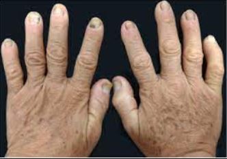 Nail Infection Resulting From Thyroid Dysfunction